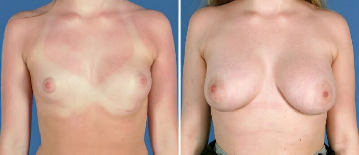 Breast Augmentation Before & After Case 25648