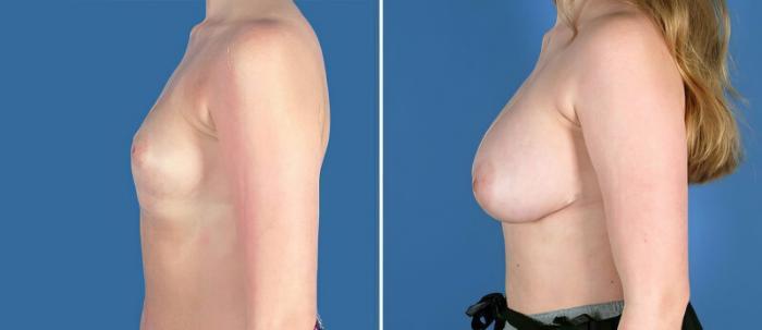 Breast Augmentation Before & After Case 25648