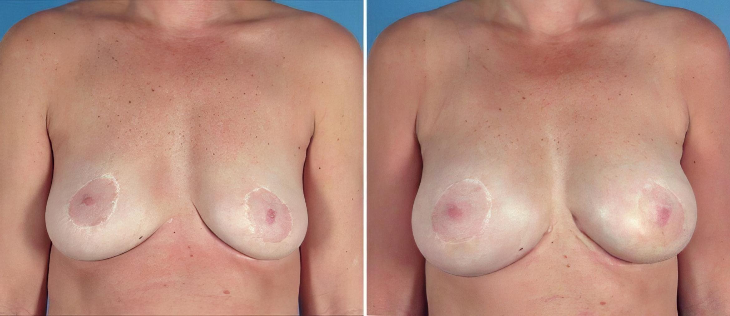 Breast Augmentation Before & After Case 25773