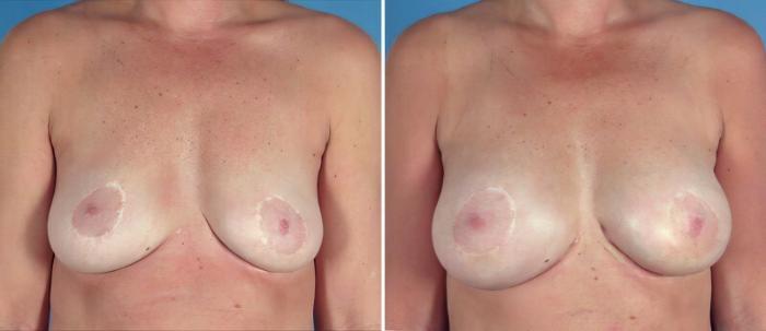 Breast Augmentation Before & After Case 25773