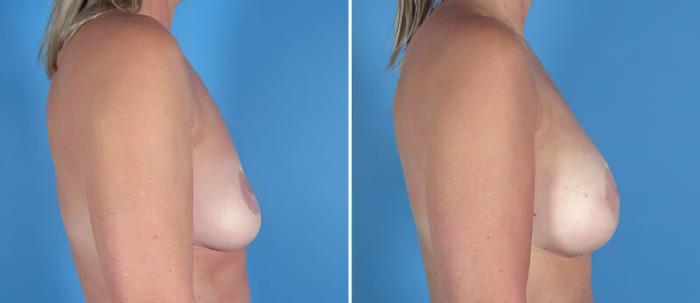 Breast Augmentation Before & After Case 25773