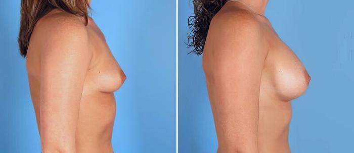 Breast Augmentation Before & After Case 25785