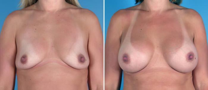Breast Augmentation Before & After Case 25810