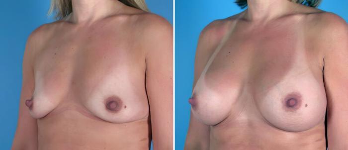 Breast Augmentation Before & After Case 25810