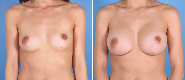 Breast Augmentation Before & After Case 25821