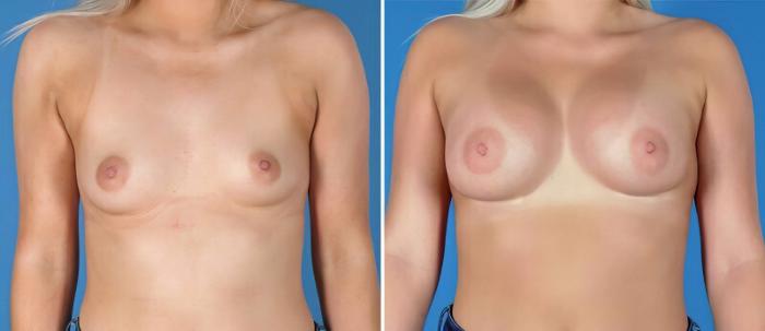 Breast Augmentation Before & After Case 25826