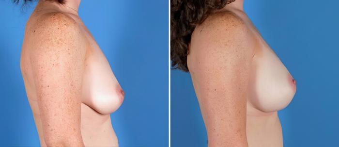 Breast Augmentation Before & After Case 25829
