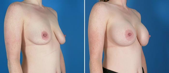 Breast Augmentation Before & After Case 26024