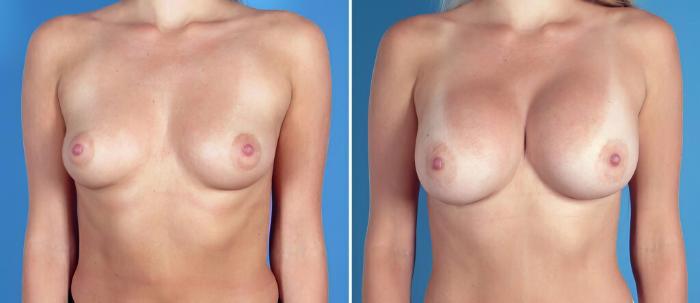 Breast Augmentation Before & After Case 26294