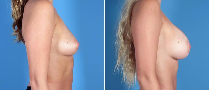 Breast Augmentation Before & After Case 26294