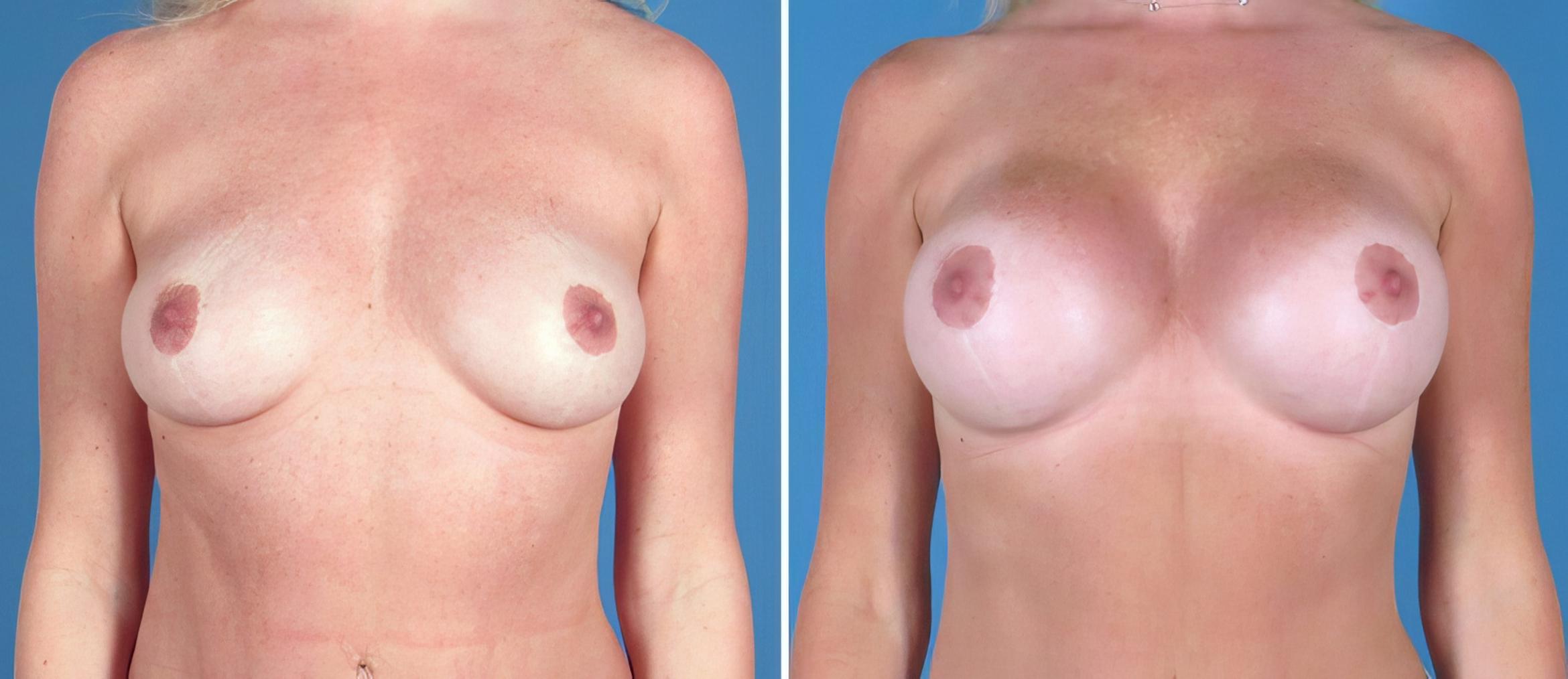 Breast Augmentation Before & After Case 26713