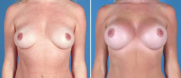 Breast Augmentation Before & After Case 26713