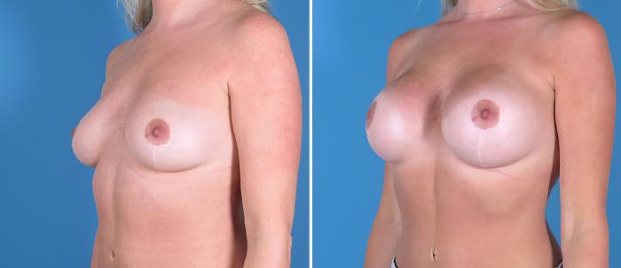 Breast Augmentation Before & After Case 26713