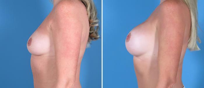 Breast Augmentation Before & After Case 26713