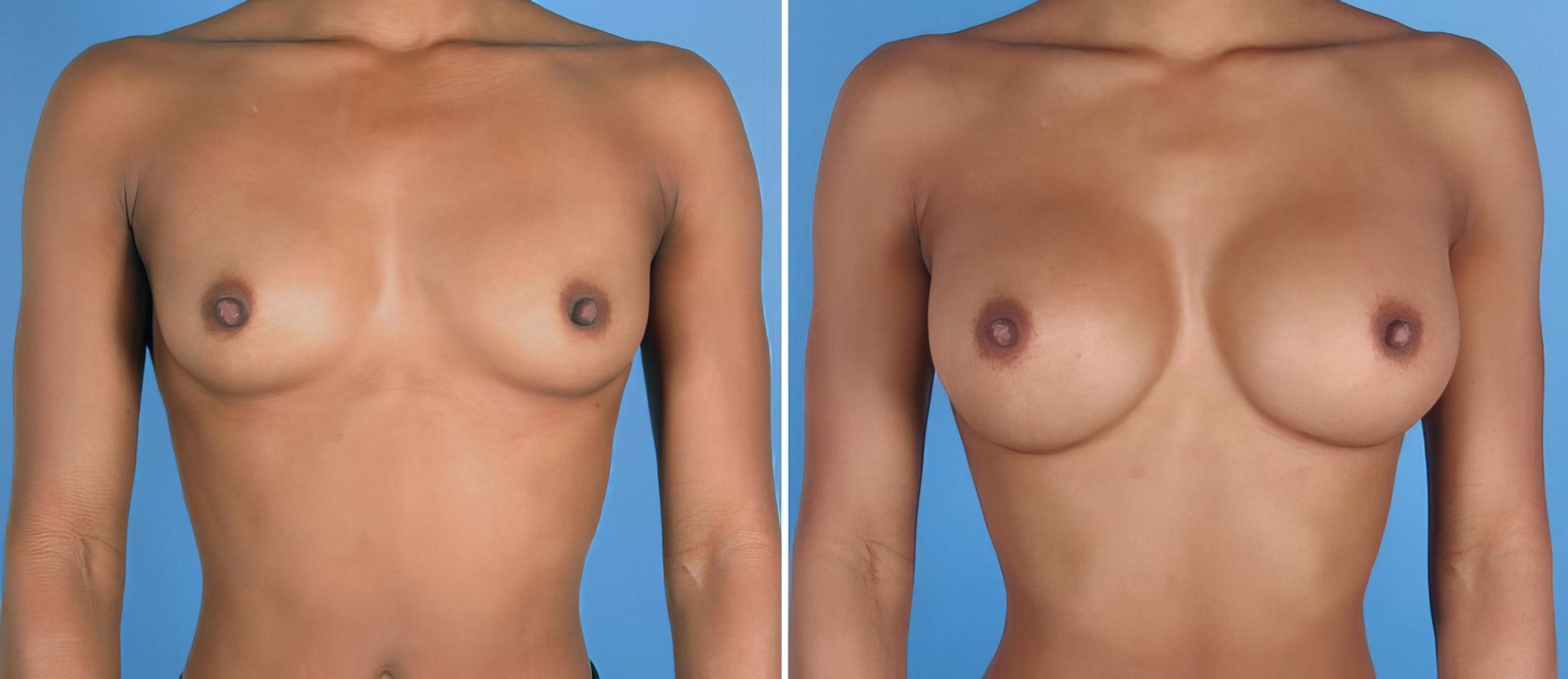 Breast Augmentation Before & After Case 26802