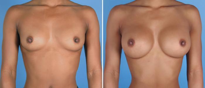 Breast Augmentation Before & After Case 26802
