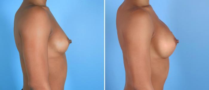 Breast Augmentation Before & After Case 26802