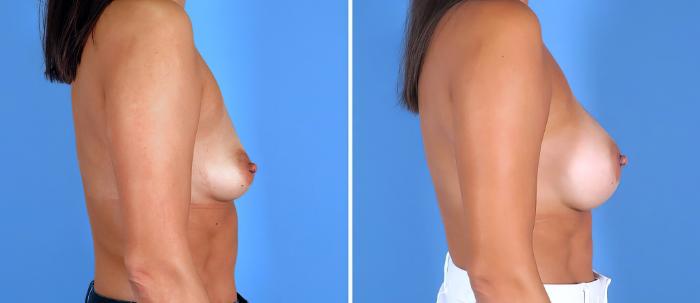 Breast Augmentation Before & After Case 26844