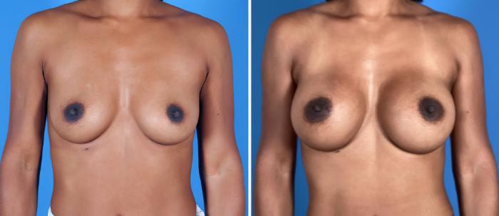 Breast Augmentation Before & After Case 27159