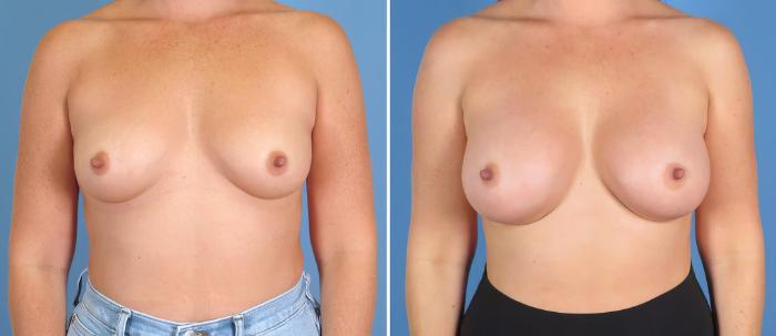 Breast Augmentation Before & After Case 27545