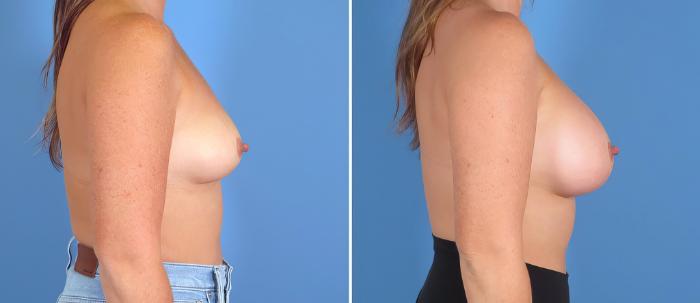 Breast Augmentation Before & After Case 27545