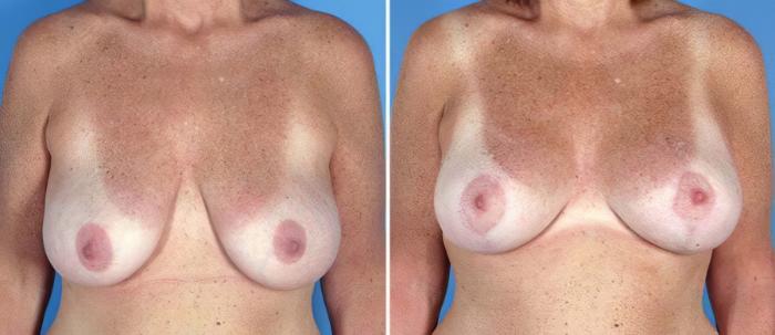 Breast Augmentation with Lift Before & After Case 17621