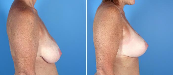 Breast Augmentation with Lift Before & After Case 17621