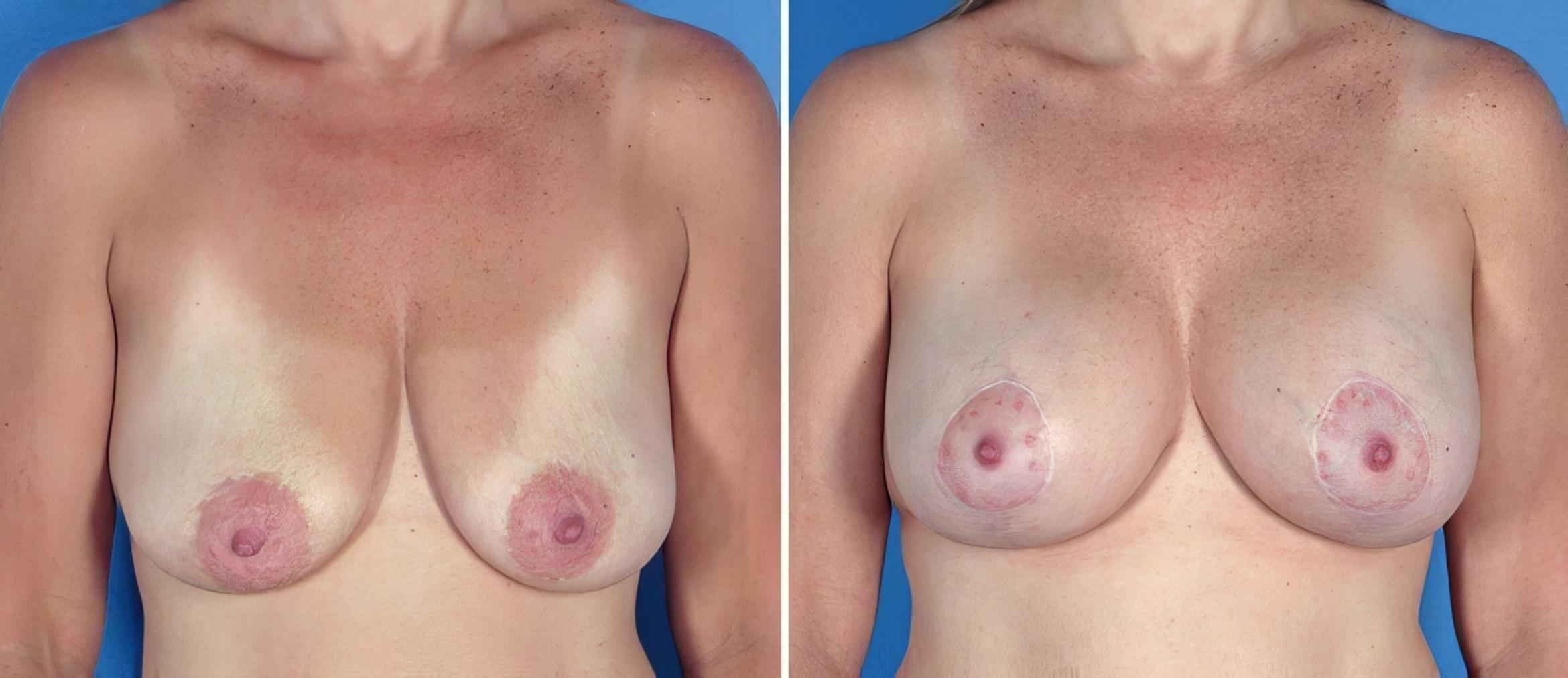 Breast Augmentation with Lift Before & After Case 17627