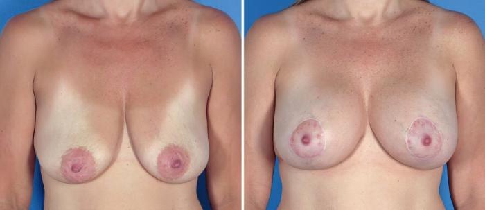 Breast Augmentation with Lift Before & After Case 17627