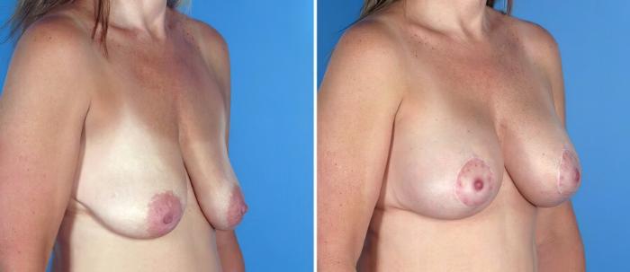 Breast Augmentation with Lift Before & After Case 17627