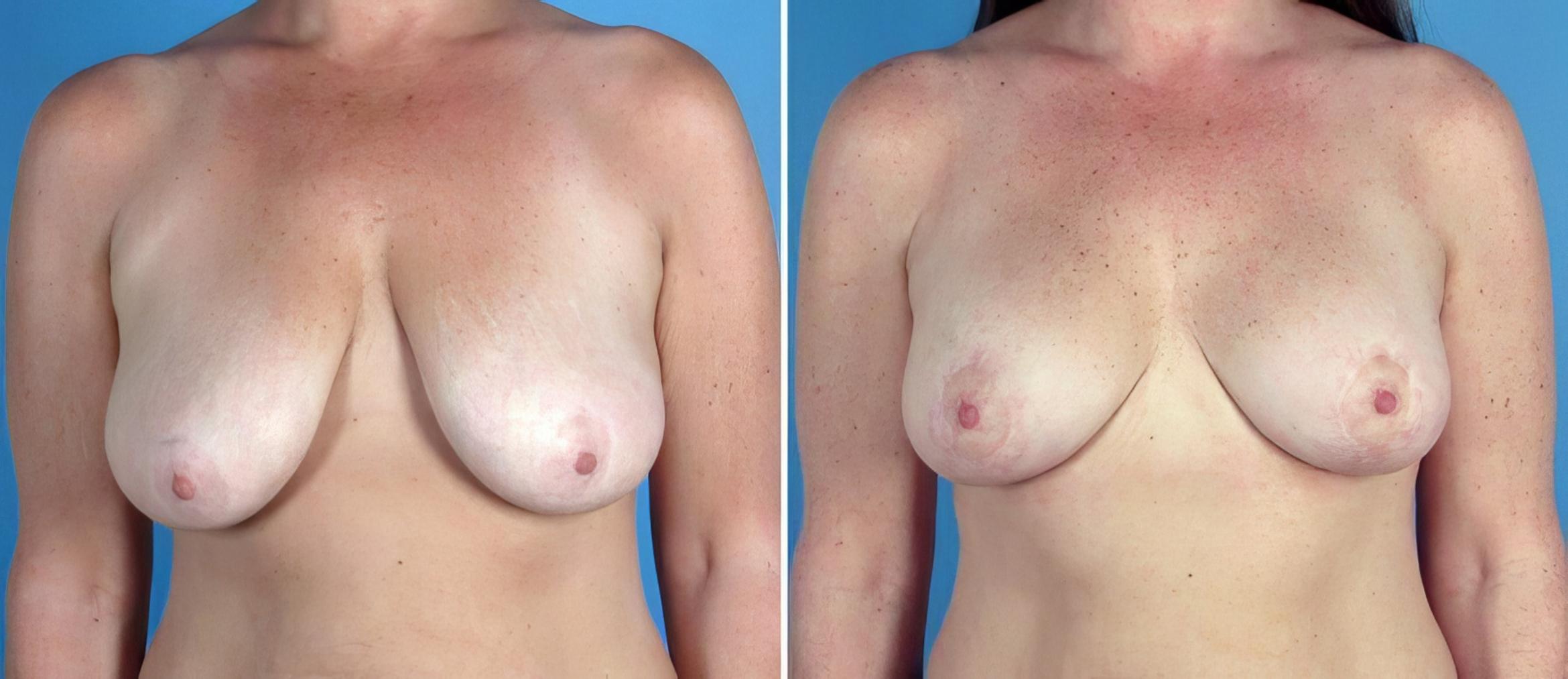 Breast Augmentation with Lift Before & After Case 17757