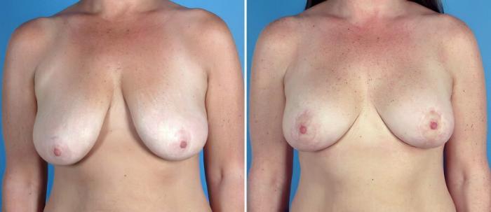 Breast Augmentation with Lift Before & After Case 17757