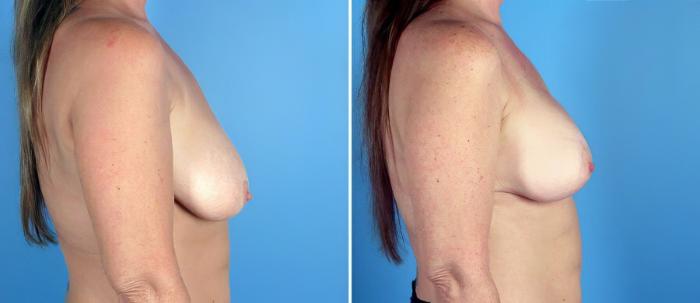 Breast Augmentation with Lift Before & After Case 17757
