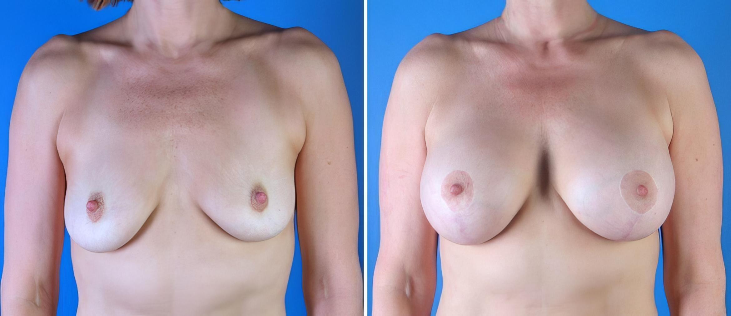 Breast Augmentation with Lift Before & After Case 17895