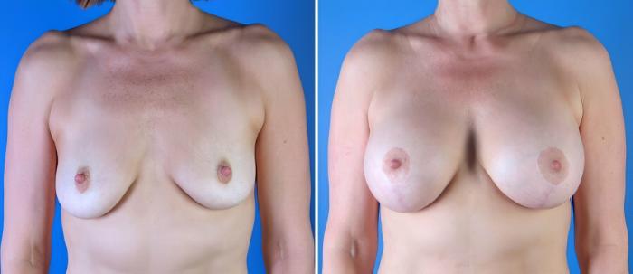 Breast Augmentation with Lift Before & After Case 17895
