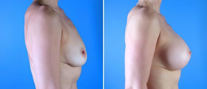 Breast Augmentation with Lift Before & After Case 17895