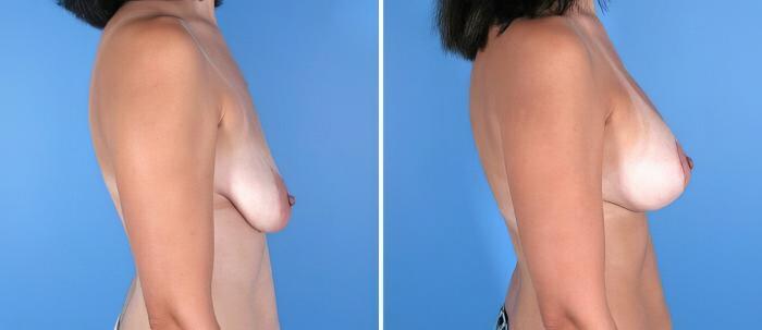 Breast Augmentation with Lift Before & After Case 17904