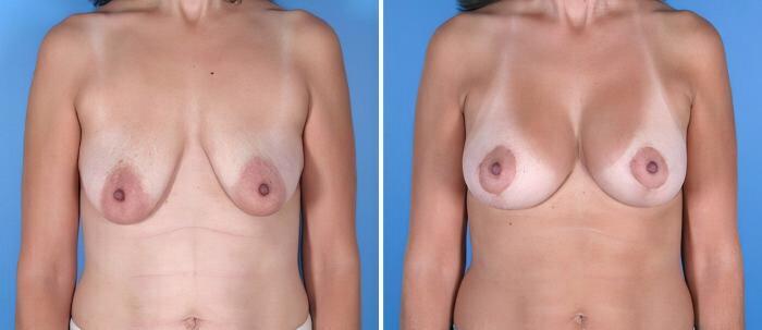 Breast Augmentation with Lift Before & After Case 17904