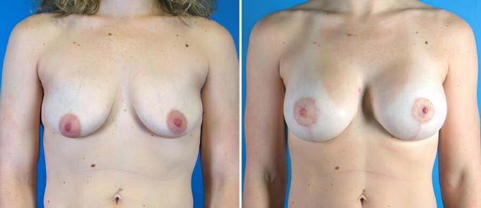 Breast Augmentation with Lift Before & After Case 17907