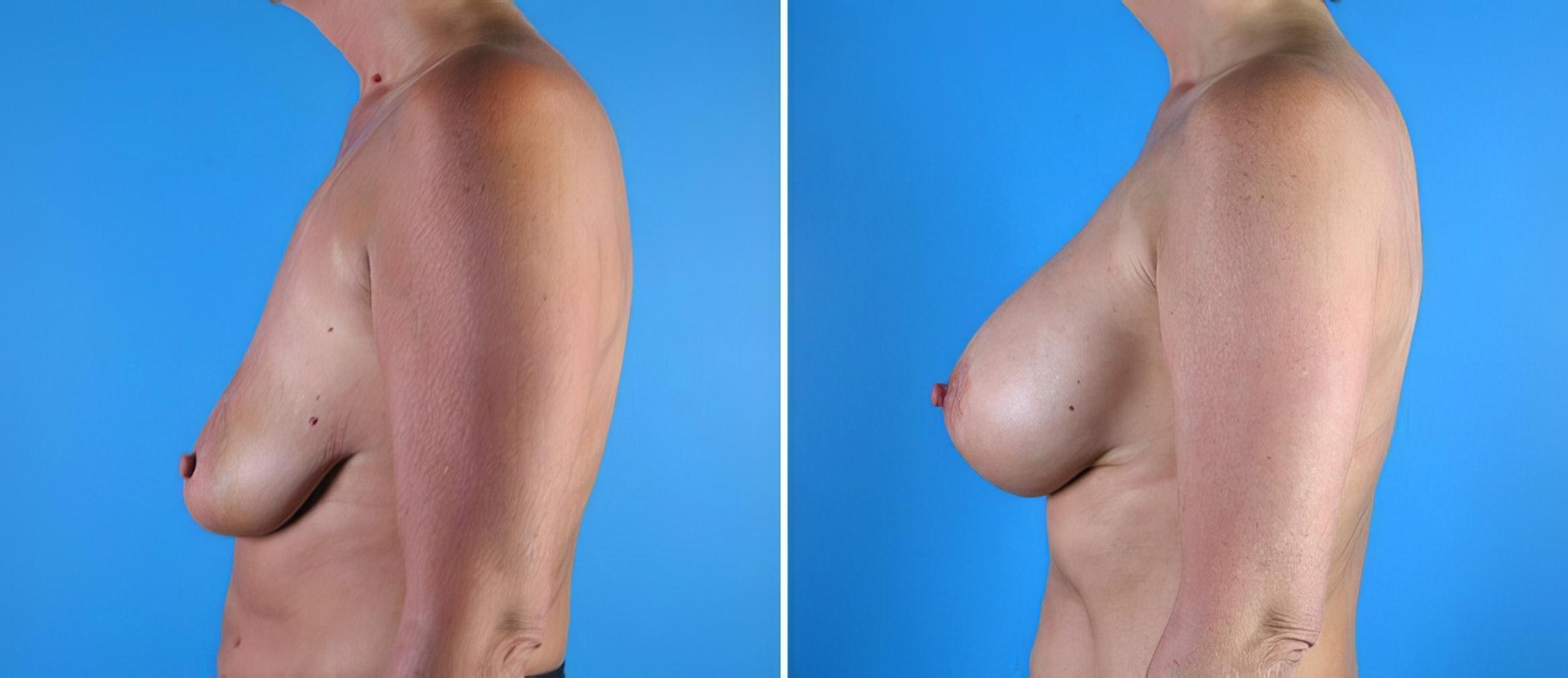 Breast Augmentation with Lift Before & After Case 17931