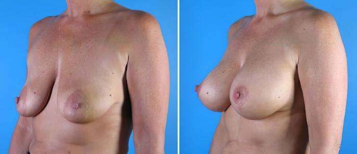Breast Augmentation with Lift Before & After Case 17931