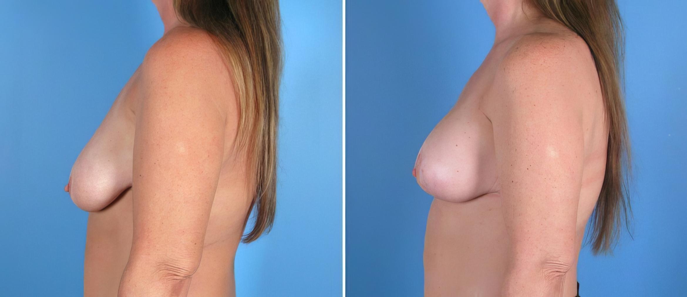 Breast Augmentation with Lift Before & After Case 17934