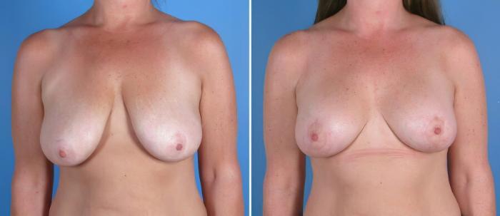 Breast Augmentation with Lift Before & After Case 17934