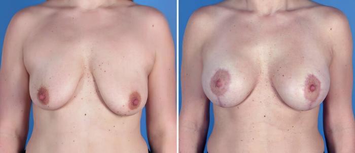 Breast Augmentation with Lift Before & After Case 18049