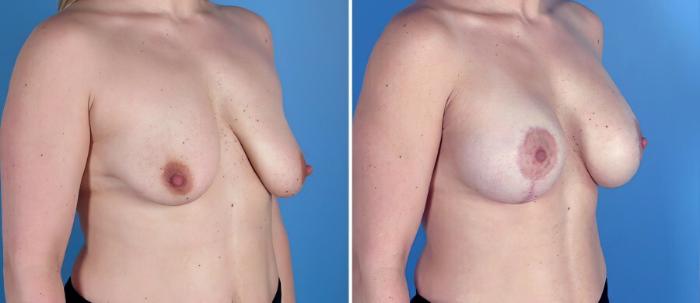 Breast Augmentation with Lift Before & After Case 18049