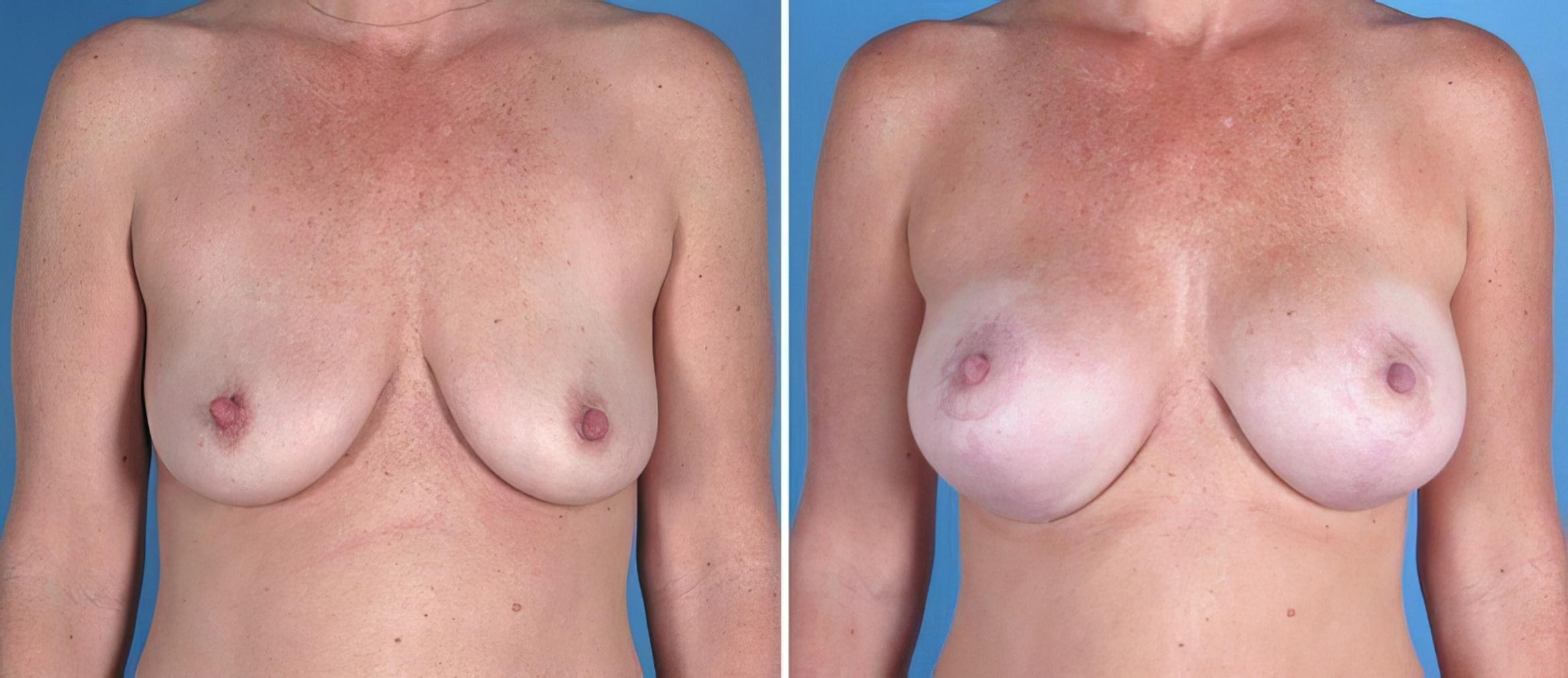 Breast Augmentation with Lift Before & After Case 18057