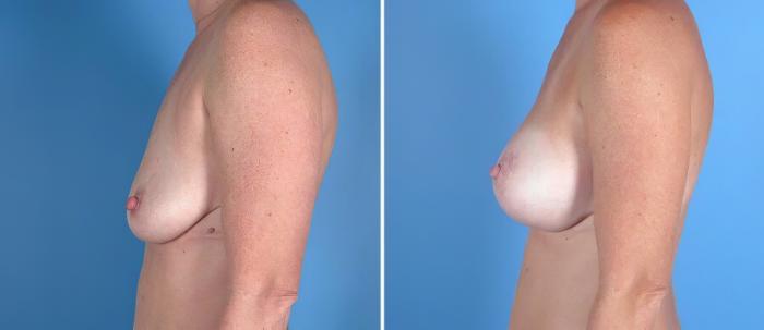 Breast Augmentation with Lift Before & After Case 18057