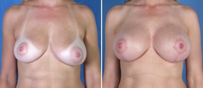 Breast Augmentation with Lift Before & After Case 18060