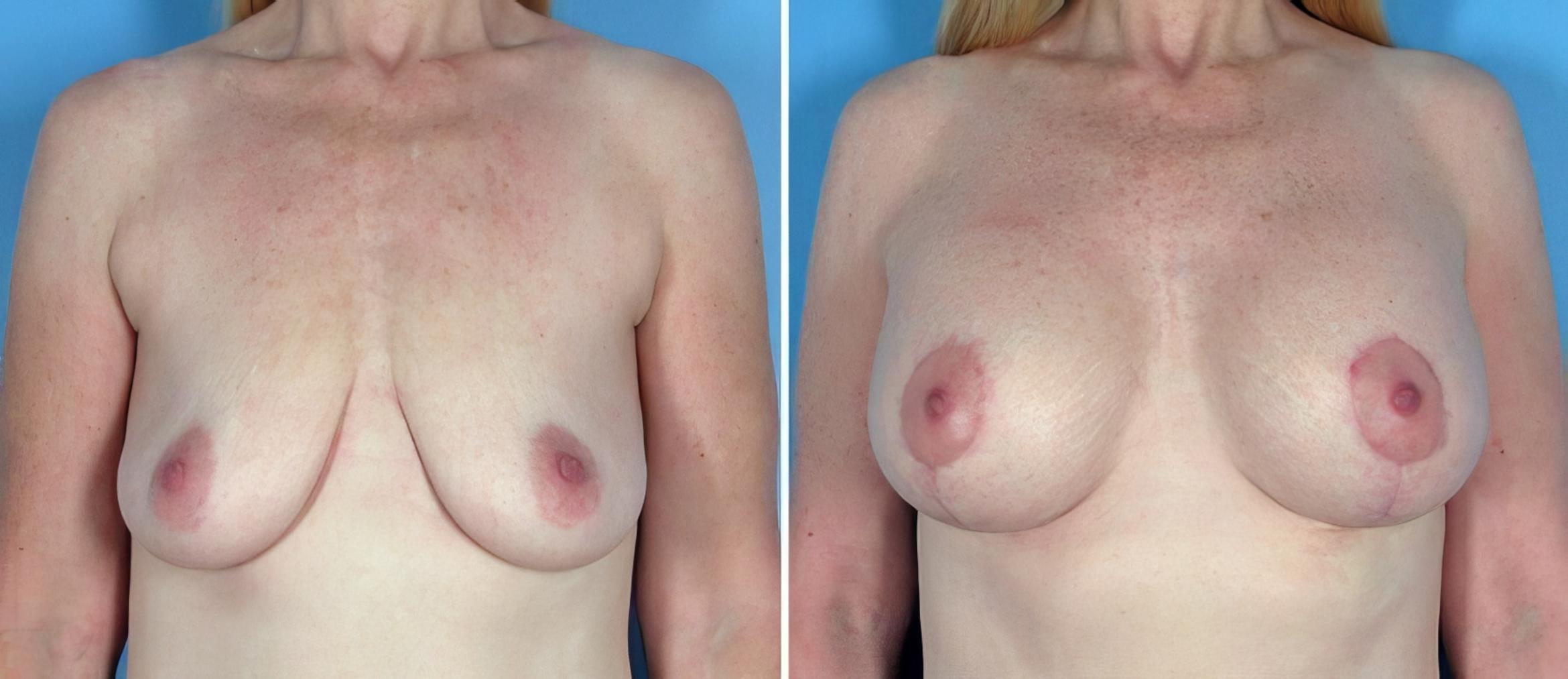 Breast Augmentation with Lift Before & After Case 18066
