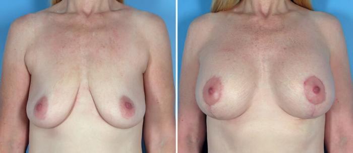 Breast Augmentation with Lift Before & After Case 18066